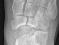 Navicular Stress Fracture Nonunion